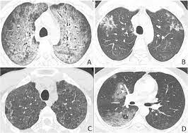 Diagnostic Performance Of Chest Ct In