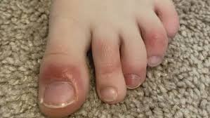 swollen toes lead to rochester boy s