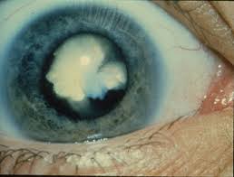 Cataract An Acute Sudden Onset Cortical Cataract In A Pers