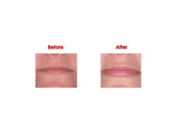 permalip lip implants clinic harley
