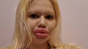 woman with world s biggest lips gets