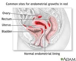 Many remain undiagnosed and are therefore not treated. Endometriosis Katy Women S Care