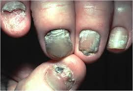 yellow nail syndrome dermatology advisor