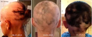 A clinical and immunohistochemical analysis. Healing Alopecia Areata Startseite Facebook