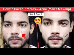 how to cover hide pimples acne men