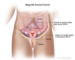 Essential used in this way means that the body does not produce the nutrient; Cervical Cancer Treatment Pdq Treatment Patient Information Nci Michigan Medicine