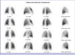 Imaging of thyroid dysfunction is safe and clinically relevant in children. Scintidome La Scintigraphie Pulmonaire