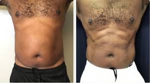 men body contouring before and after
