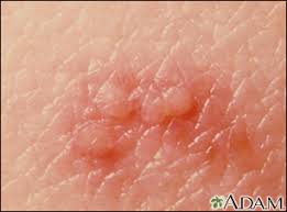 shingles herpes zoster symptoms and