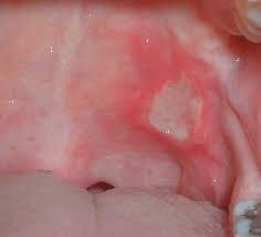 mouth ulcers and canker sores