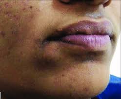 vermilion border of the lower right lip