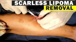 lipoma removal cost short