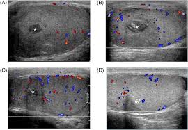 role of multiparametric ultrasound in