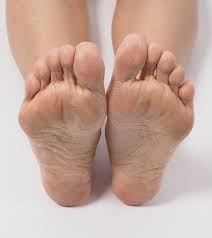 dead skin under feet causes symptoms