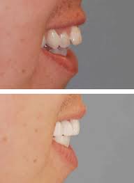 Mandibular osteotomy (lower jaw) mandibular osteotomy surgery corrects a severely receded lower jaw. Underbite And Overbite Correction Without Surgery