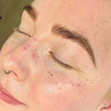 how long do freckle tattoos last