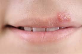 cold sores herpes simplex i dental