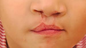 genetics in cleft lip formation