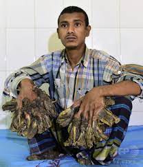 バングラデシュの「樹木男」 巨大イボ除去手術へ 写真6枚 国際ニュース：AFPBB News