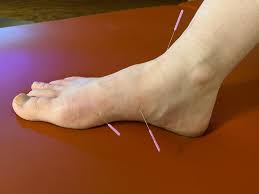 plantar fasciitis foot pain