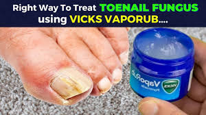 toe nail fungus with vicks vaporub