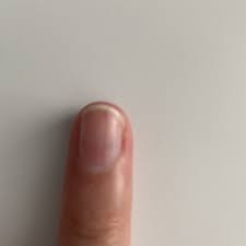vertical line on my fingernail mumsnet