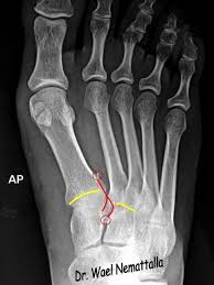Check spelling or type a new query. Emrad Radiologic Approach To The Traumatic Foot X Ray