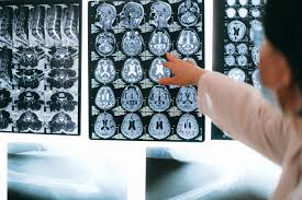 what to expect during a brain mri