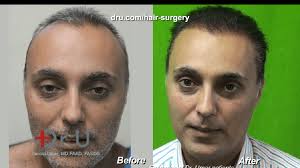 results after a hair transplant