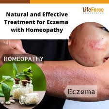 treatment for eczema with homeopathy