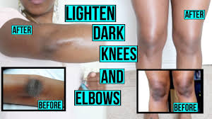 12 home remes for dark elbows and