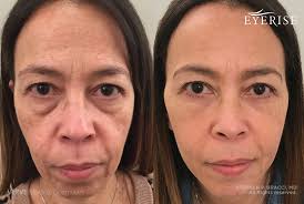 Also, undereye fillers won't do much for larger bags under their eyes, dr. Under Eye Filler Treaments In Nyc Verve Medical Cosmetics