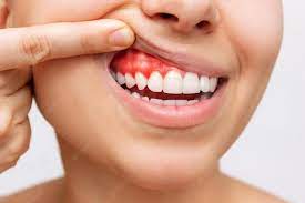 bleeding gums causes and home remes