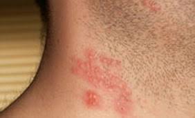 The sores may be painful and unsightly. Clinical Presentations Of How Hsv 1 Hsv 2 Can Present