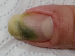 the complexities of the green nail syndrome