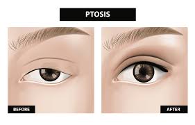 what causes ptosis and how is it