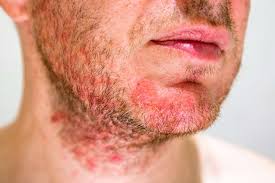 what an hiv rash looks like 9 types