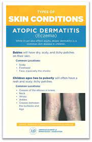 atopic dermais eczema diagnosis and