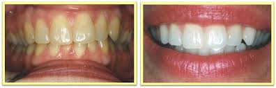 zoom whitening moon twp pa teeth