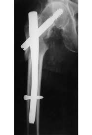 ap view of a trochanteric fracture