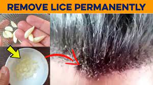 home remes to eliminate lice infestation