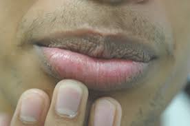removal of brown spots on the lips