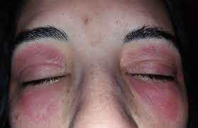 eyelid dermais causes symptoms