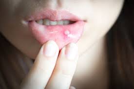 8 causes of a mouth ulcer facty health