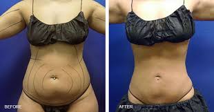 what is laser lipo chicago chicago