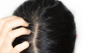 Everything you need to know about grow everything out about an inch, keeping the hair around your bald spot slightly longer than on the. Does Scalp Eczema Cause Hair Loss