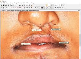 flap in secondary cleft lip deformities