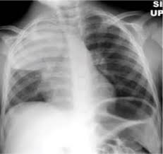 What is apico lordotic means. Tuberculosis Radiology Wikipedia