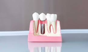 how much does dental implants cost