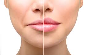 lip fillers